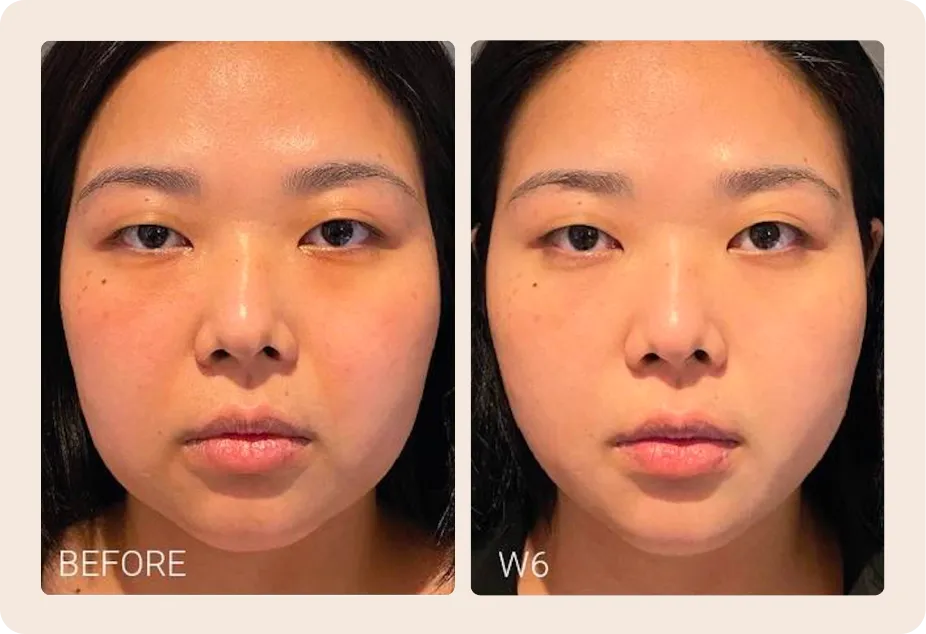 Actual treatment case by SALIENT. Results may vary and require professional physician evaluation.