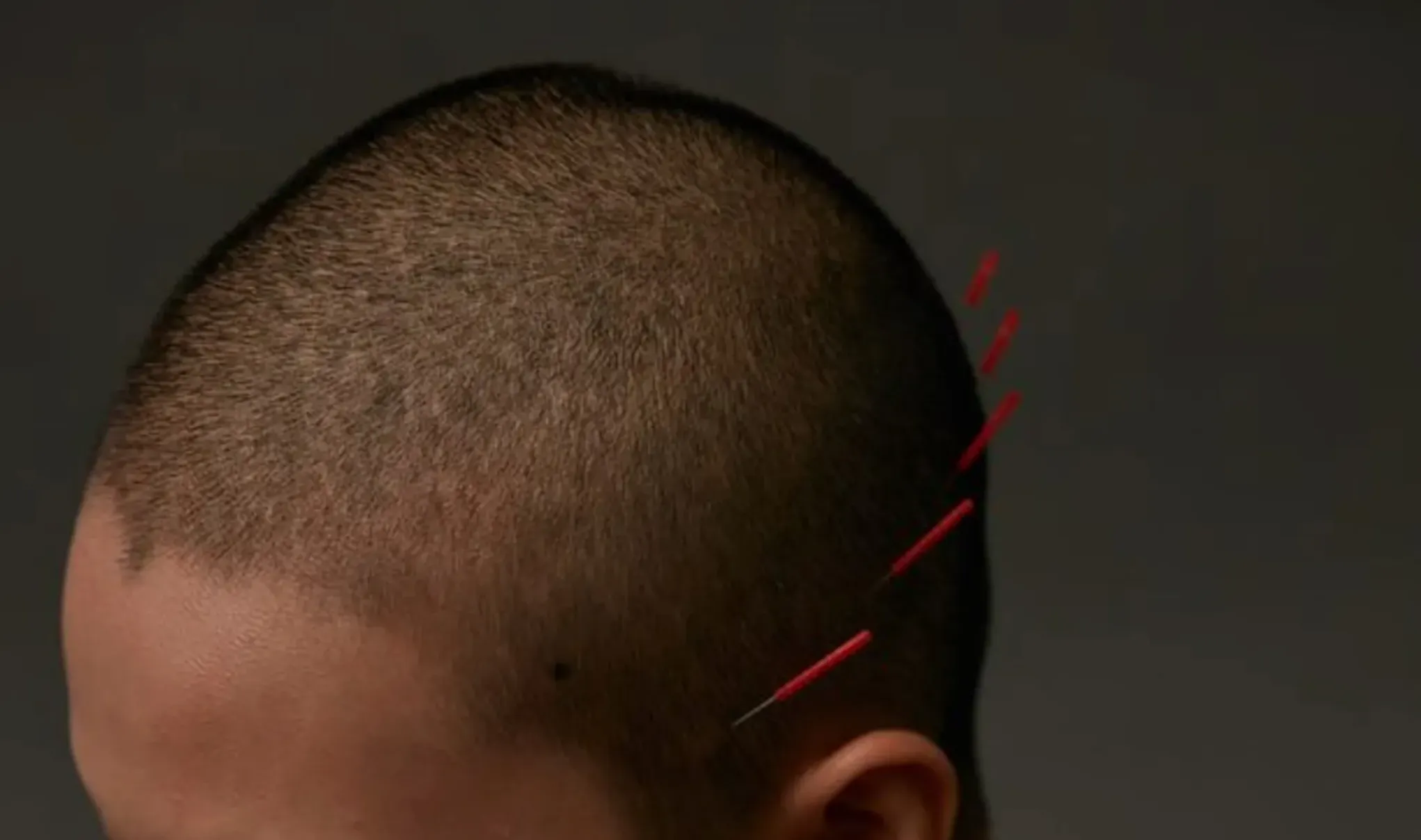 Salient, Taiwan’s first TCM facial acupuncture clinic authorized to use Japanese 0.1 mm needles