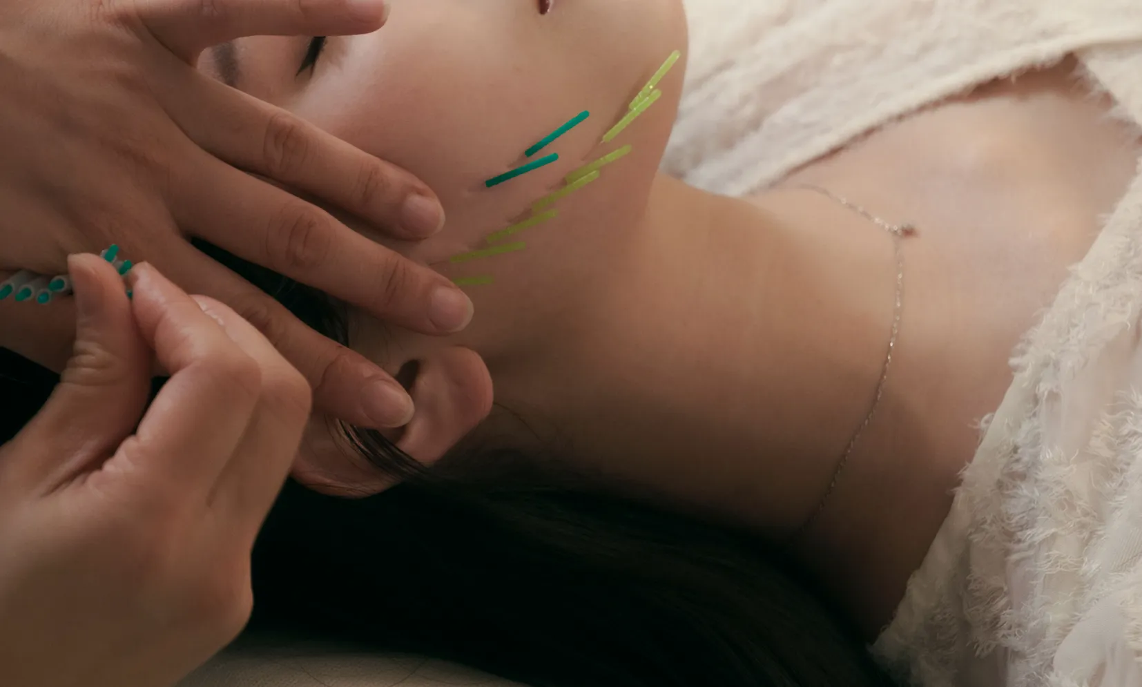 Facial acupuncture jawline treatment representing the introduction of Korean aesthetic acupuncture techniques in 2015